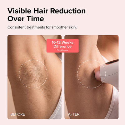 Radivex™ IPL hair removal device
